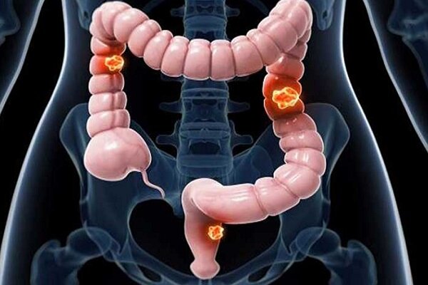 تاثیر ورزش در افزایش طول عمر بازماندگان سرطان روده بزرگ