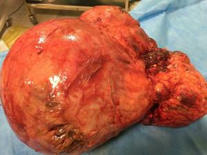 خروج توده 15 کیلویی از شکم پیرمرد 72 ساله در بیمارستان شهید دکتر رهنمون