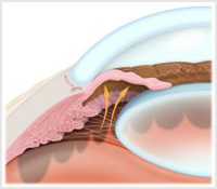 آب‌ سیاه‌ چشم‌، نوع‌ زاویه‌ بسته‌ اولیه‌ ـ glaucoma primary close angle