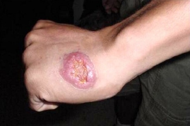 کاهش ۵۰ درصدی سالک در یزد با اقدامات پیشگیرانه دانشگاه علوم پزشکی